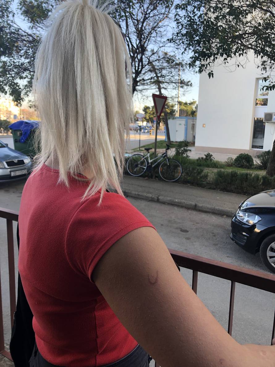 Napadnuta učenica: 'Ožiljak je možda trajan, loše se osjećam'