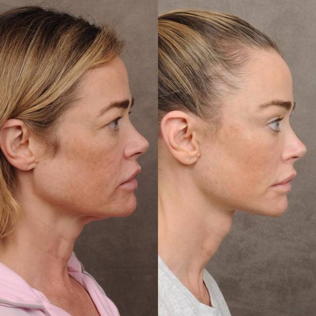 Denise Richards na faceliftingu: Sheenova bivša pokazala je fotke prije i poslije zahvata