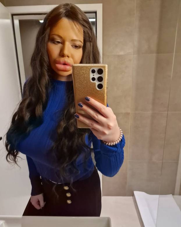 FOTO Žena s najvećim usnama na svijetu otkrila kako je nekoć izgledala: Šok! Bila si prekrasna