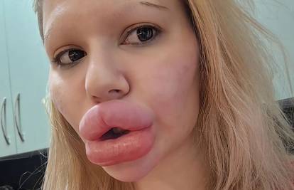 Žena s najvećim usnama na svijetu sada je stavila filere oko nosa kako bi 'izjednačila' lice