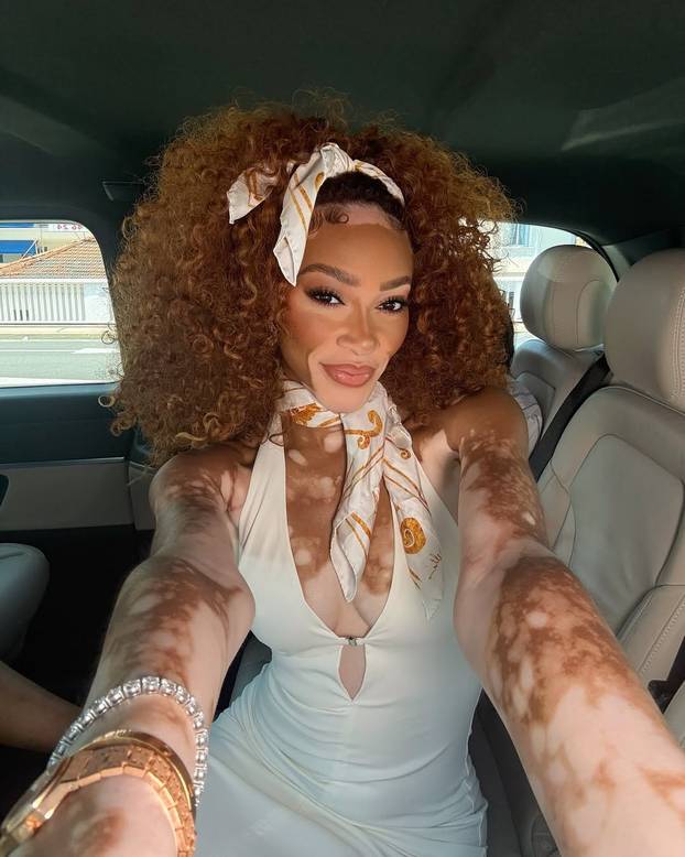 FOTO Rugali su joj se zbog bolesti, a danas je obožavaju zbog jedinstvenog izgleda