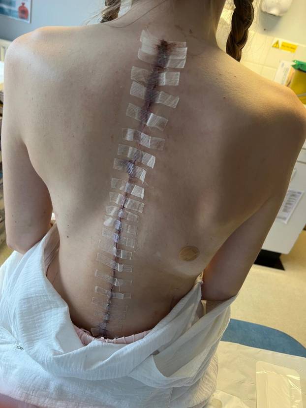 'I survived FIVE open-heart surgeries and stand three inches taller after life-changing spinal operation'