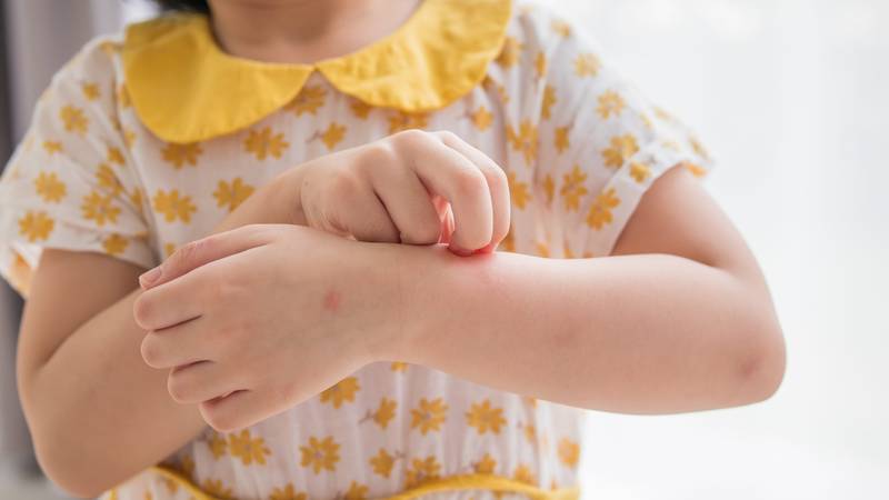 Opasni simptomi alergija kod djece: Stručnjakinja otkrila kada treba otići kod liječnika