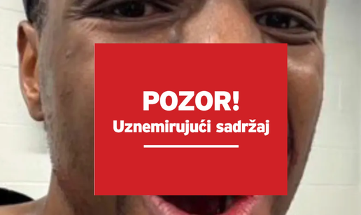 FOTO Stra&scaron;na ozljeda u NBA ligi! Zvijezda zadobila frakturu zuba