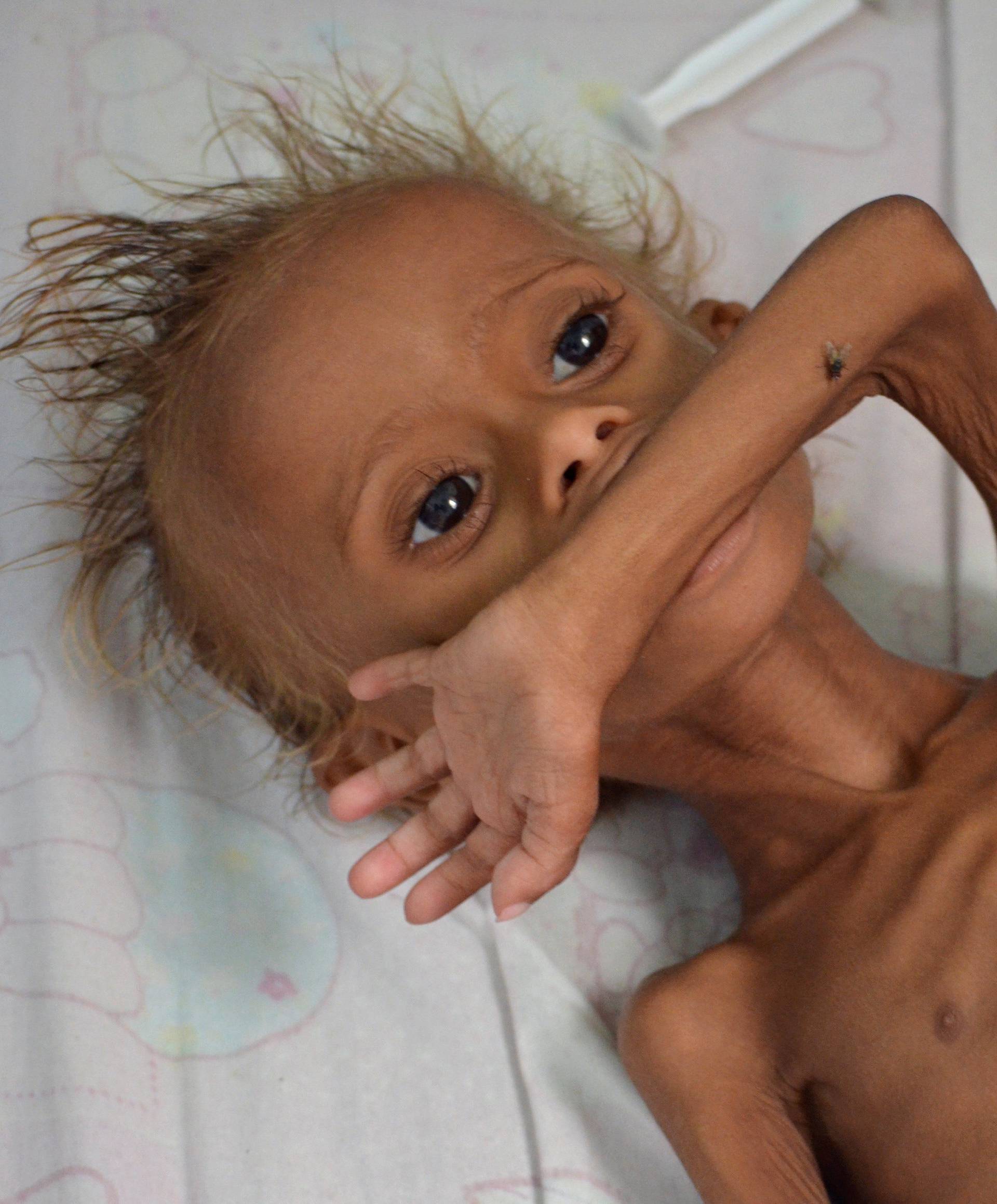 Malnourished boy lies on a bed at a hospital in the Red Sea port city of Houdieda