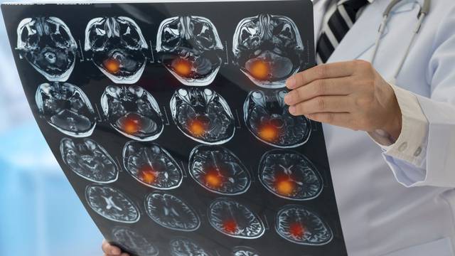 Znanstvenici slučajno došli do zaključka što se događa s mozgom netom prije smrti