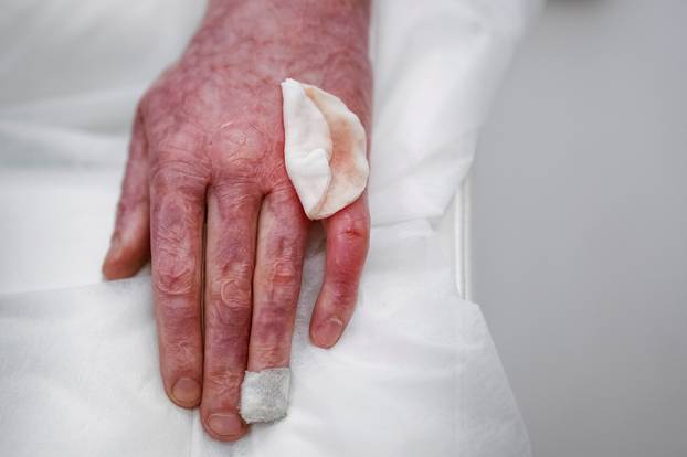 Former Ukrainian serviceman, who was wounded at a front line, comes to a clinic to treat scars, in Kyiv