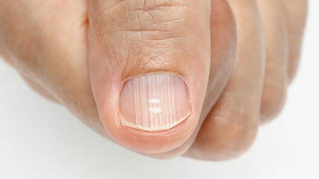 Evo što otkrivaju vodoravni ili okomiti nabori na noktima
