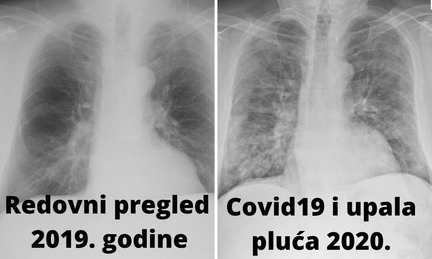 Covid je Hrvatu uništio zdrava pluća: 'Prošle godine su bila čista. Posljedice će biti trajne'