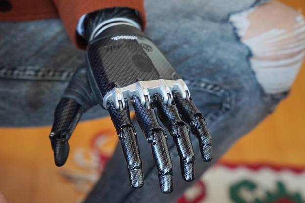 Mladić iz BiH nakon teške prometne nesreće dobio je mioelektronsku ruku