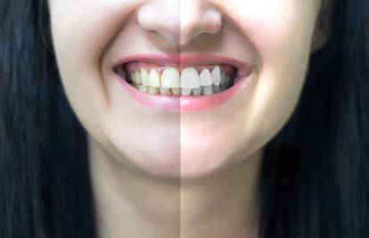 Ovo su razlozi zbog kojih imate žute zube, a ne biserno bijele