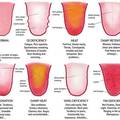 Boja jezika otkriva zdravstvene probleme - rak, moždani udar...