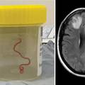 Prvi slučaj u svijetu: Ženi su iz mozga izvukli živog crva dugog 8 cm, koji je inače u pitonima