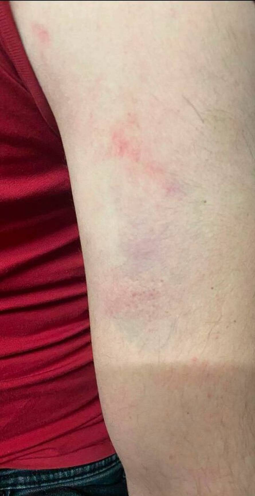 Motociklistima opet postavili zamku: 'Naletili smo na sajlu, dečko se danas jedva kreće...'