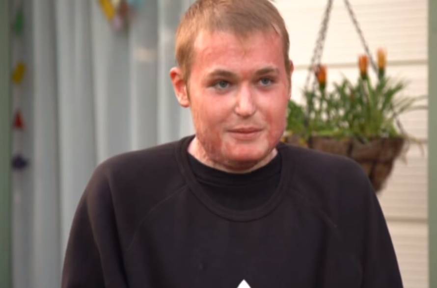 Preživio je erupciju vulkana, a sada uči kako ponovno hodati