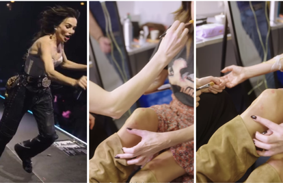 VIDEO Severina pokazala modrice od pada na koncertu u Areni: 'Tek je sutra boljelo'