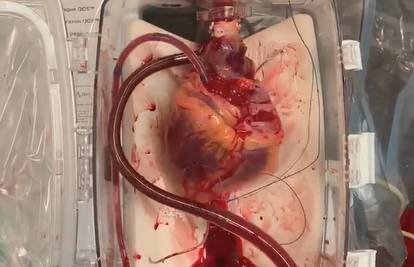 Liječnici pokrenuli mrtvo srce kisikom, krvlju i elektrolitima