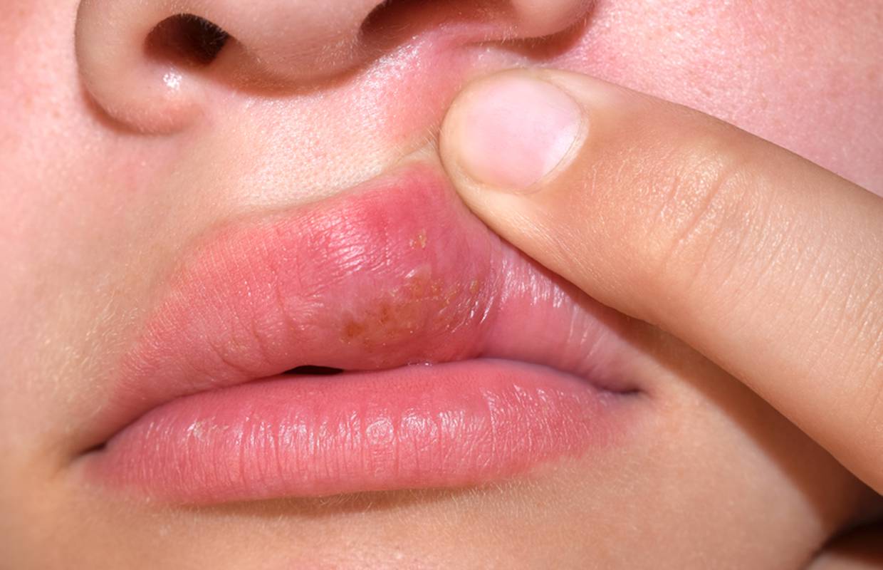 Opasna zaraza: Miješa se DNK oralnog i genitalnog herpesa