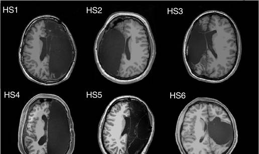 Ljudi s pola mozga: Imaju iste funkcije, mozak se prilagodio