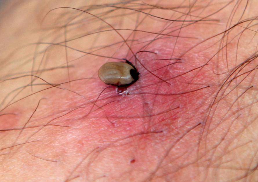 Žena pokazala kako se obranila od krpelja: Ljepljiva traka je hit!