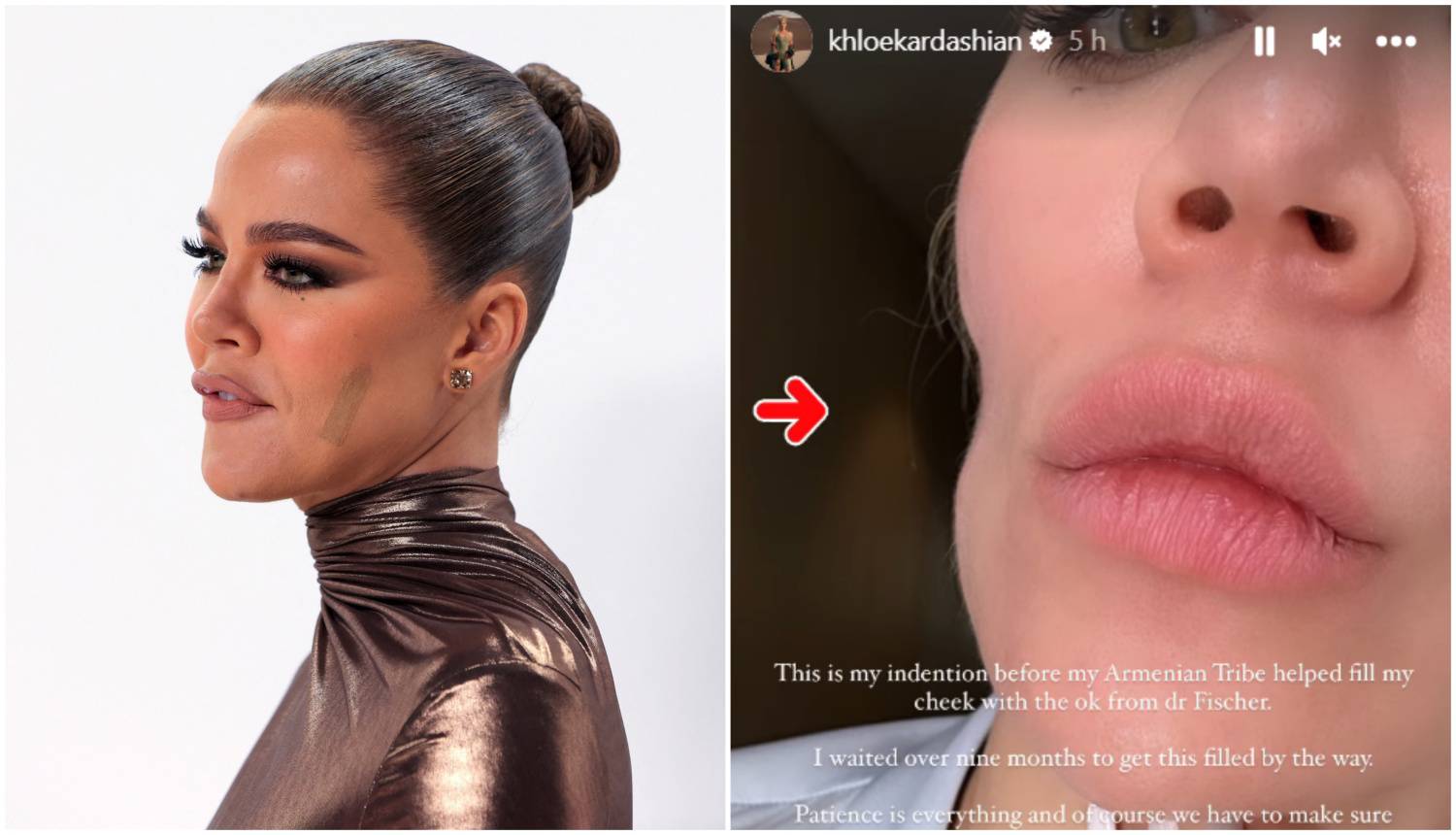 Khloe Kardashian pokazala lice nakon operacije: 'Imala sam rak kože, ostalo mi je udubljenje...'