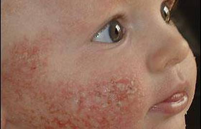 Kineski kožni  kauč 'spalio' lice 9-mjesečnom dječaku