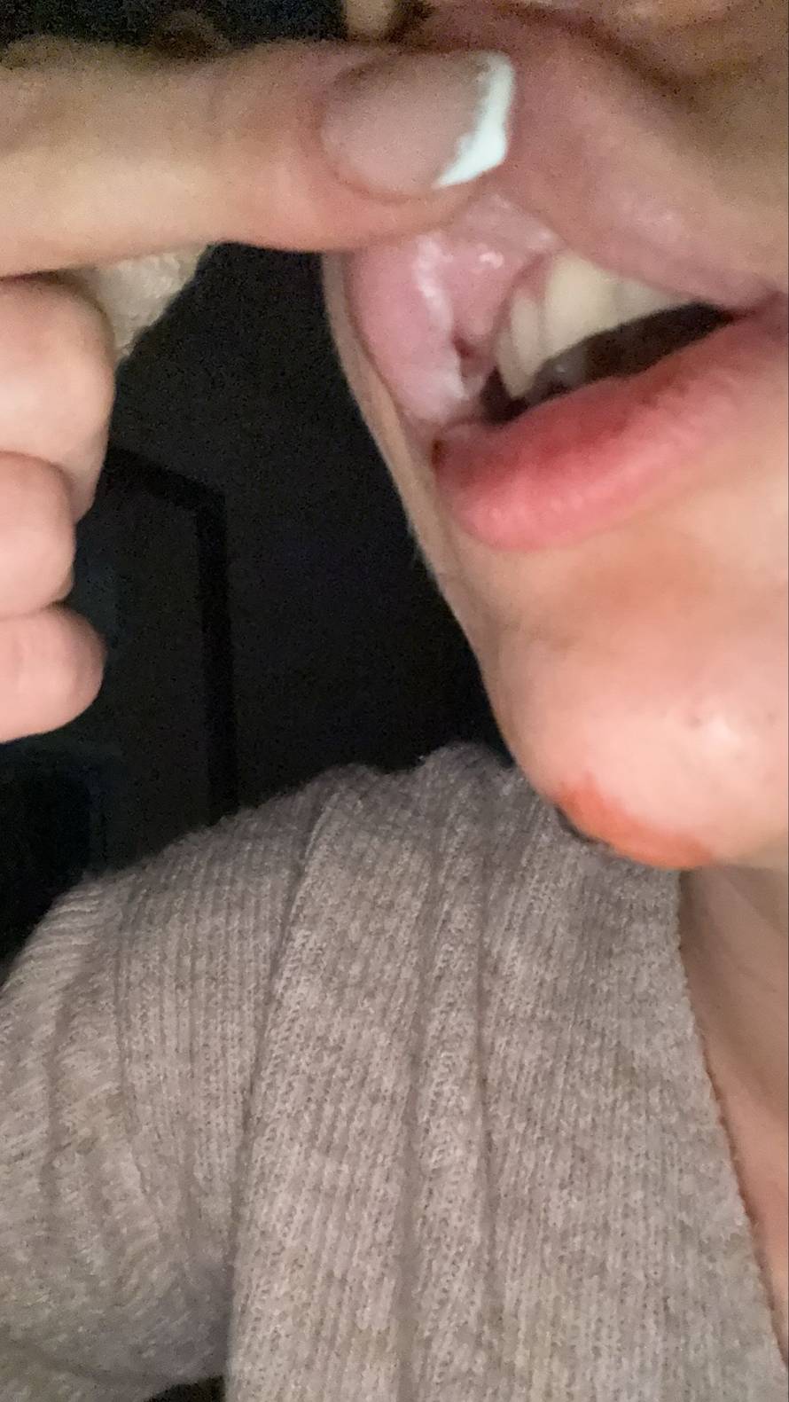 UŽAS U BEOGRADU Pretukli Hrvate u novogodišnjoj noći: 'U Zemunu su mi krivo zašili jezik'