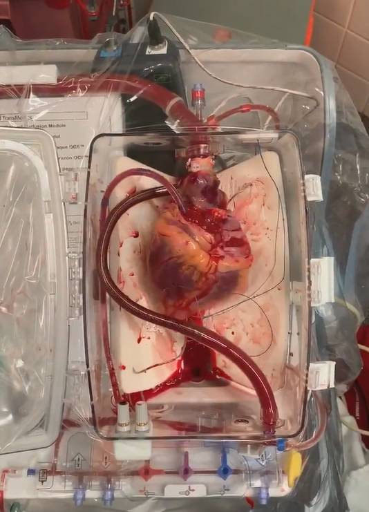 Liječnici pokrenuli mrtvo srce kisikom, krvlju i elektrolitima