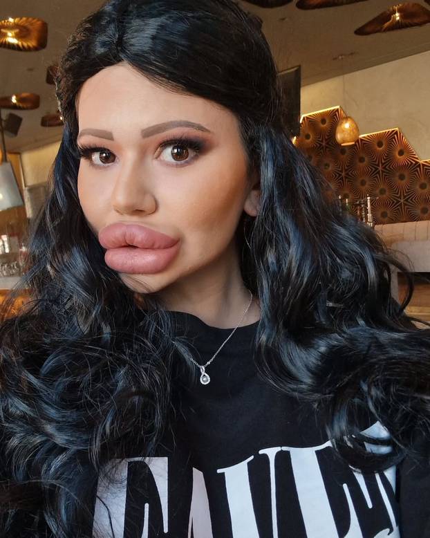 FOTO Žena s najvećim usnama na svijetu otkrila kako je nekoć izgledala: Šok! Bila si prekrasna