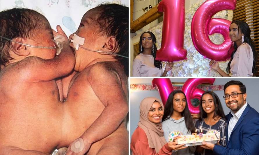 Rodile se sa spojenim prsima, a danas su zdrave srednjoškolke