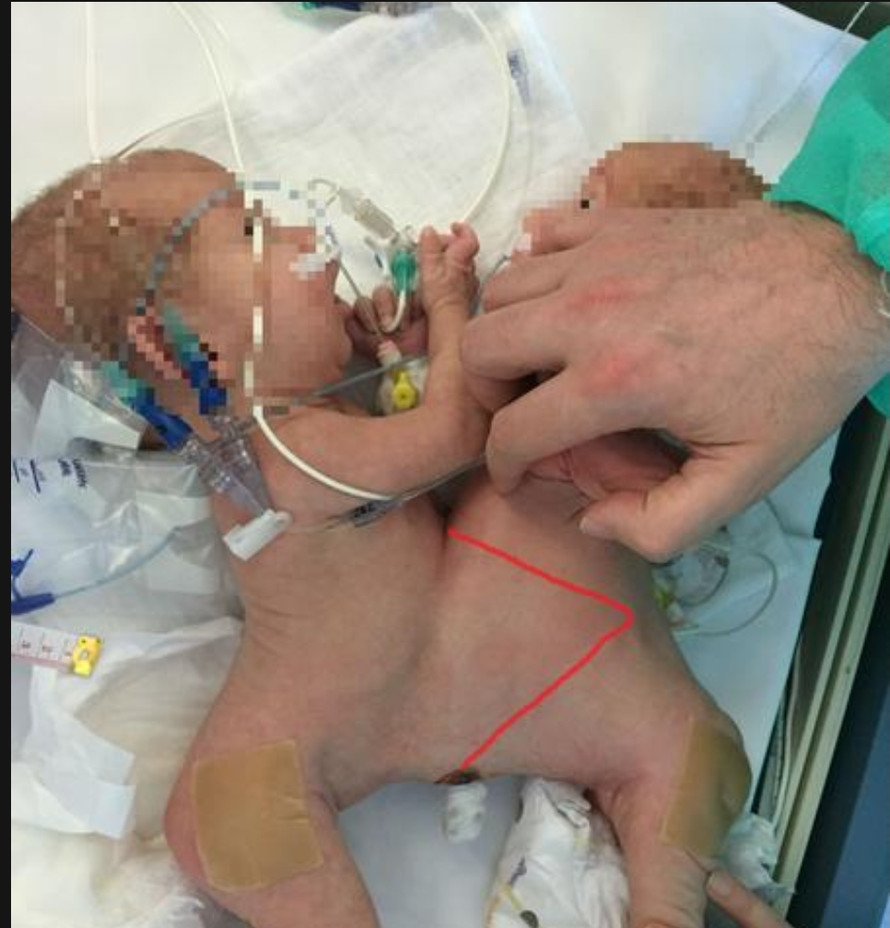 Sijamske blizanke: Seke su bile spojene, imale su zajedničku jetru, a danas su zdrave i vesele