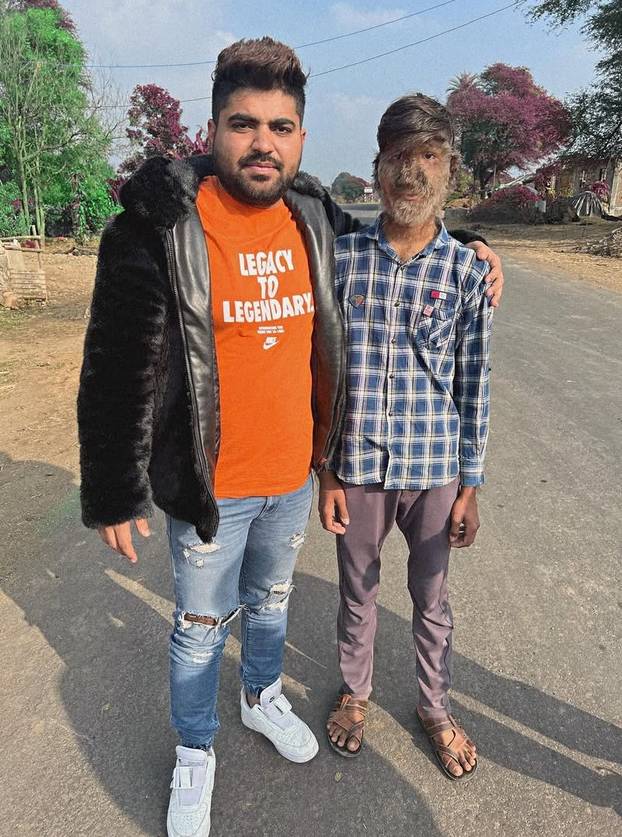 FOTO Ovaj mladić (18) pati od sindroma vukodlaka: U školi me sprdaju, ali volim svoje dlake...