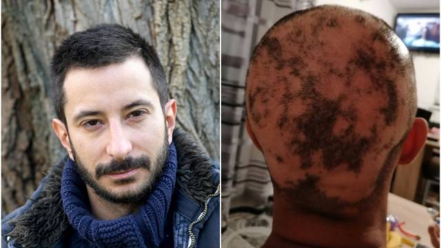 Asim Ugljen o posljedicama alopecije: 'Ovako to izgleda kad vas jako napadne. Nije ugodno'