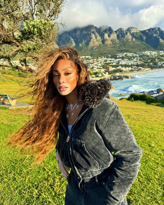 FOTO Rugali su joj se zbog bolesti, a danas je obožavaju zbog jedinstvenog izgleda