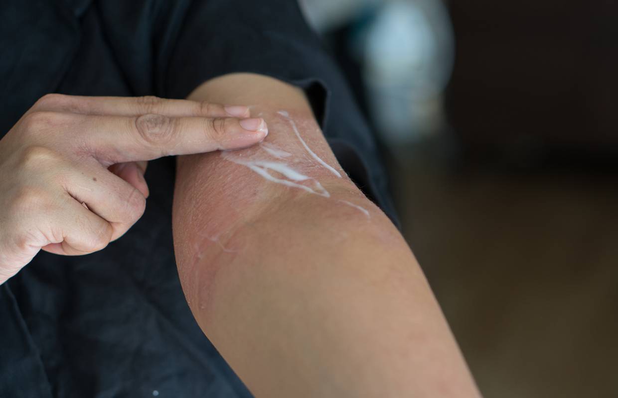 5 savjeta kako koristiti kremu za atopijski dermatitis