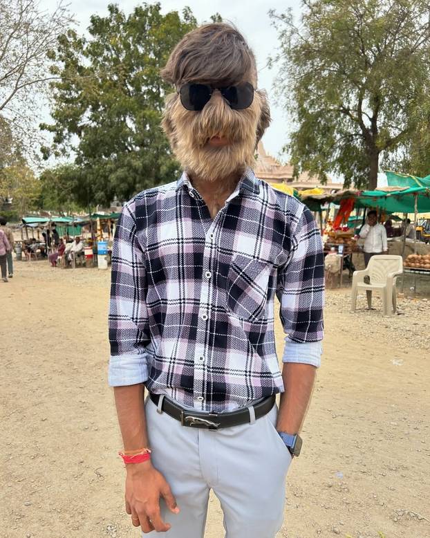 FOTO Ovaj mladić (18) pati od sindroma vukodlaka: U školi me sprdaju, ali volim svoje dlake...