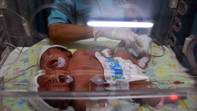 Two Headed Baby Born In Indonesia