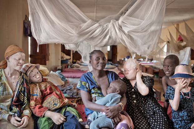 Persecuted: Albino People Seek Refuge From Vicious Body Part Traffickers