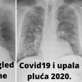 Covid je Hrvatu uništio zdrava pluća: 'Prošle godine su bila čista. Posljedice će biti trajne'