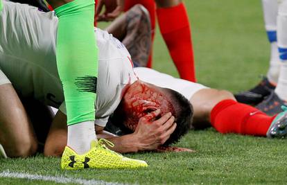 Krv na sve strane  i 15 šavova: Giroud je doživio užasan sudar