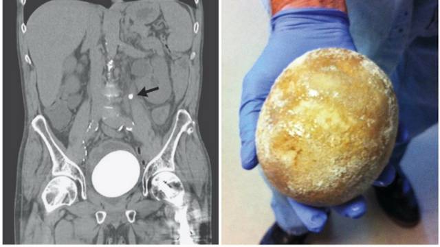 Liječnici iz muškarca izvadili kamenac veličine nojevog jajeta
