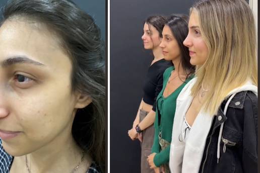 VIDEO Tri sestre otišle su na operacije nosa, rezultati sve šokirali: 'Pa to nisu iste osobe!'