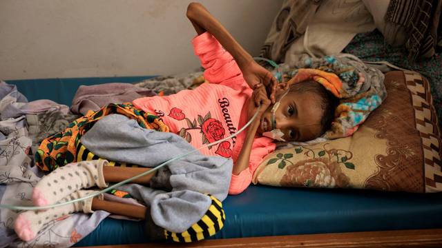 Tsige Sisay, 10, a severely malnourished girl lies on her bed at the Ayder Referral Hospital in Mekele