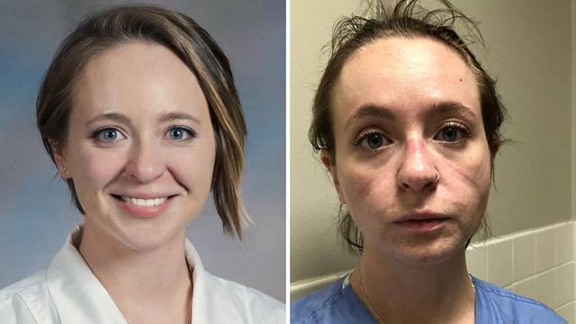 Lice medicinske sestre prije i 8 mjeseci poslije početka korone