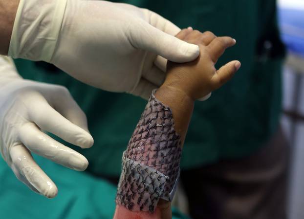 The Wider Image: Healing burns with fish skin