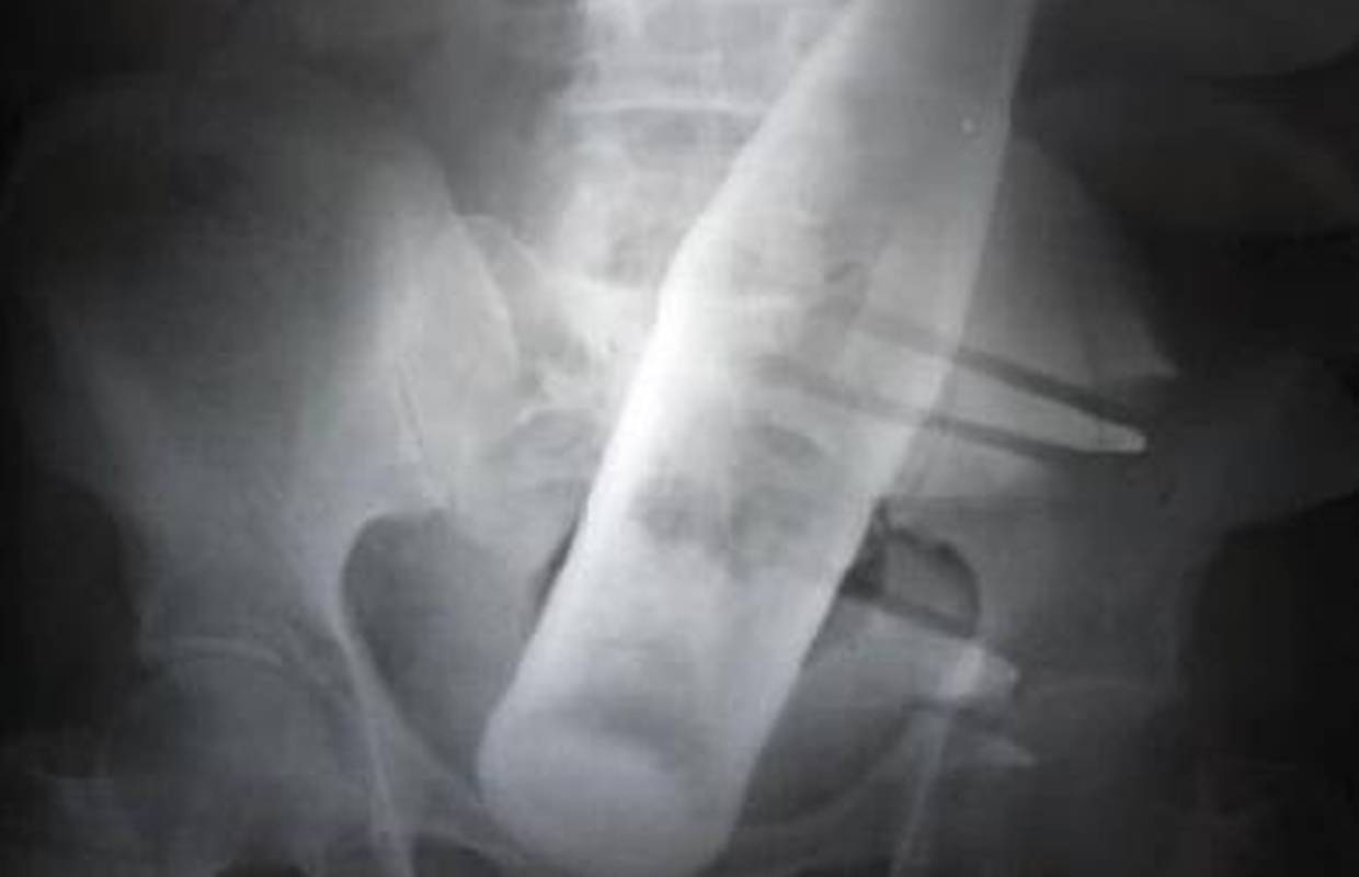 Pakistancu liječnici izvadili bocu iz donjeg abdomena