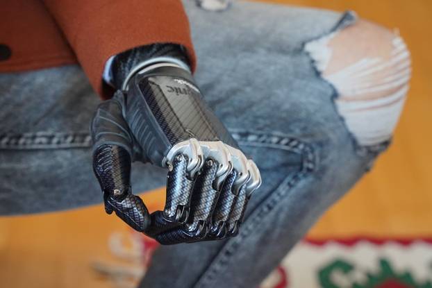 Mladić iz BiH nakon teške prometne nesreće dobio je mioelektronsku ruku