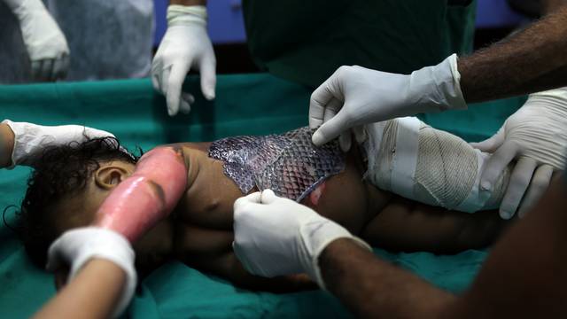 The Wider Image: Healing burns with fish skin