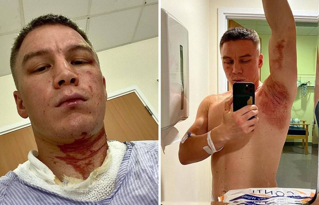 Bivšeg boksačkog prvaka napali prije meča: Sklupčao sam se od bolova, zalili su me kiselinom!