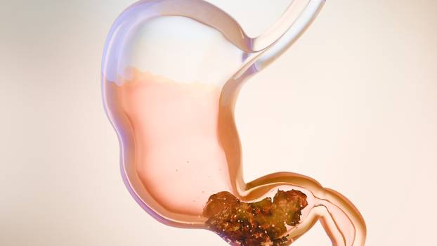 Sumnjate na gastritis? Evo koji su uzroci, simptomi, kako ga liječiti i koje su komplikacije